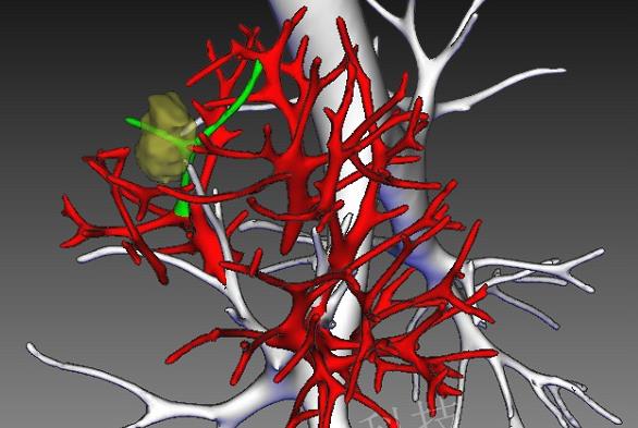 专家解答-关于肺癌在人工智能的应用
