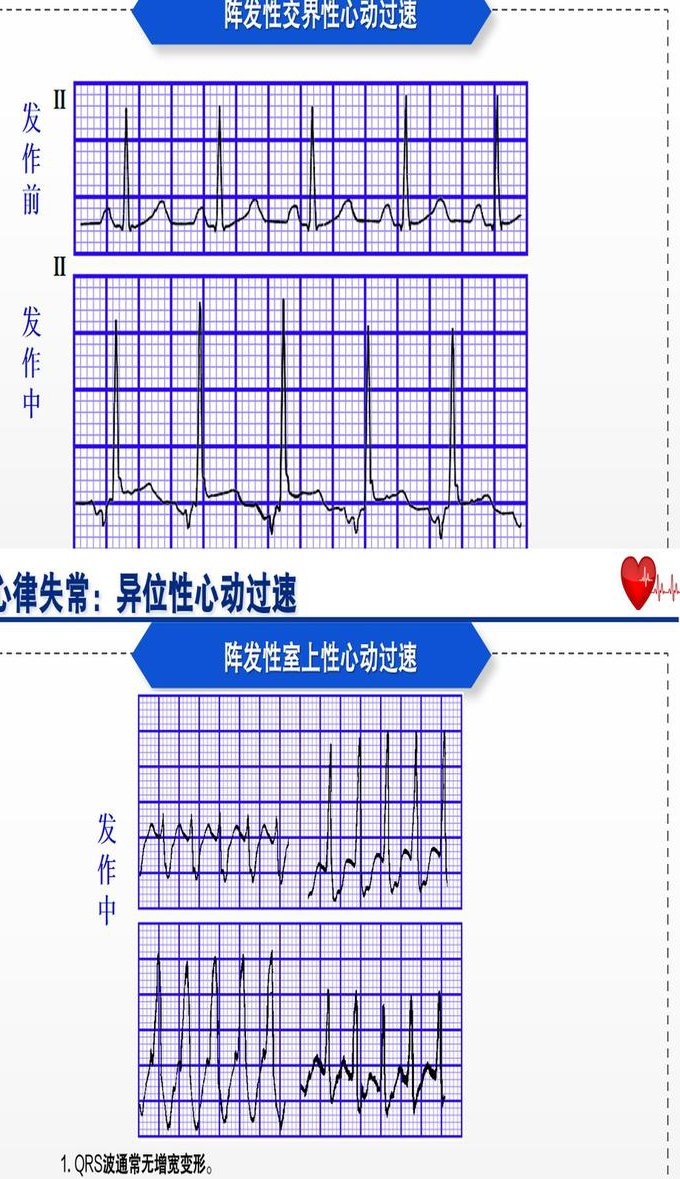 郭雅卿《心电图》课程 - 心电图基础
