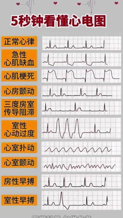 影像读片与心电图视频教学 - 心电图分析