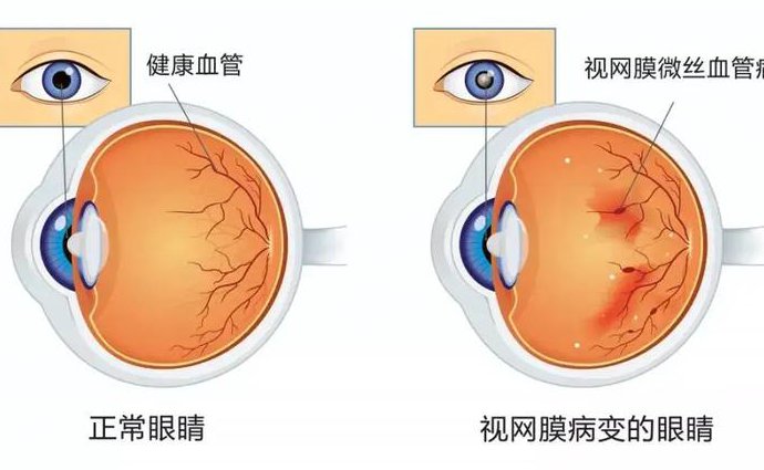 眼科学课程（首都医科大学） - 视网膜病变