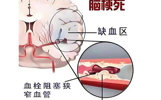 缺血性脑血管疾病教学视频 - 脑血管疾病