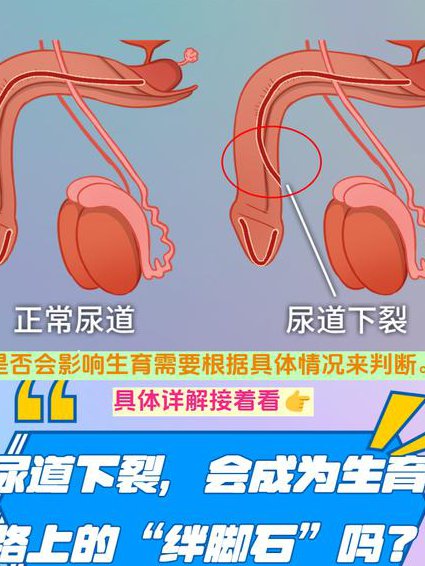 尿道下裂，看看专家怎么说 - 尿道下裂